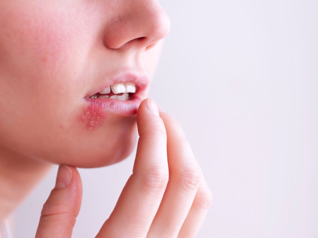 Afte e herpes: cosa sono, qual e' la differenza e come trattarli