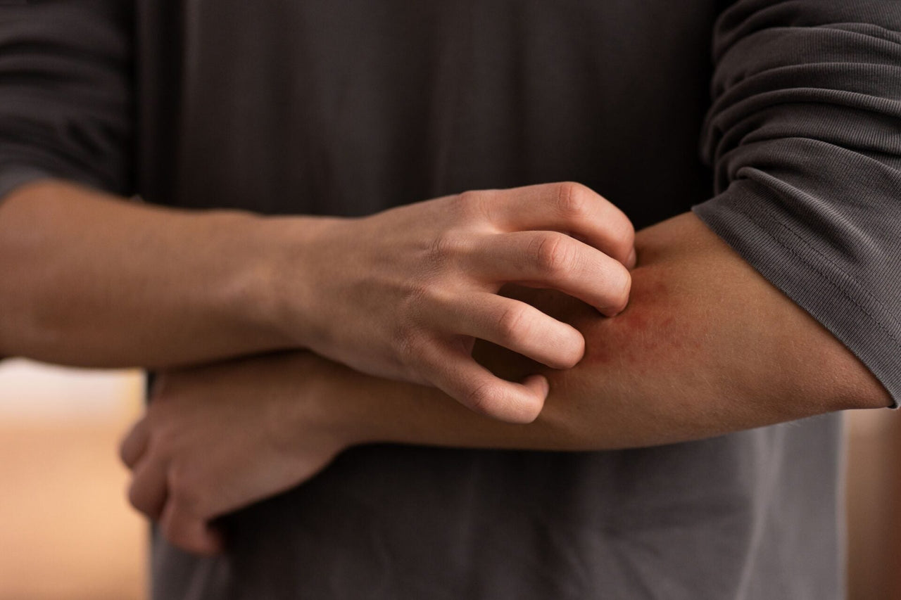 Orticaria da stress: sintomi, durata e i migliori rimedi