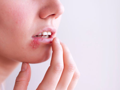 Afte e herpes: cosa sono, qual e' la differenza e come trattarli